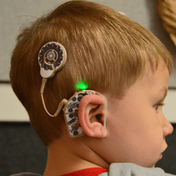 Cochlear Implants