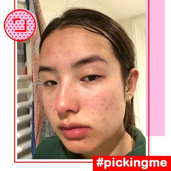 Dermatillomania aka Skin Picking Disorder/ Excoriation/ Excoriation