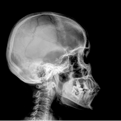 Expanding the Spectrum of Gorham-Stout Disease