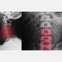 Financial Times: Charities create fund to invest in spinal cord injury companies 