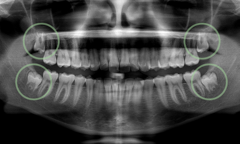 removing wisdom teeth