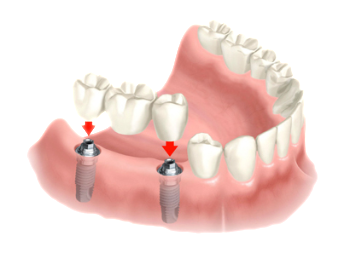 dental implant bridge