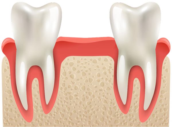 Jaw Bone Augmentation in Nebraska | Omaha Oral Surgery