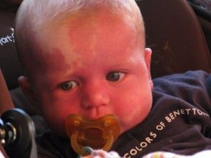 Little boy with pacifier and birthmark on face