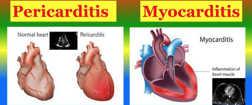 Myocarditis & Pericarditis: 5 Things You Must Know