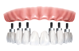 Hybrid Implant Denture