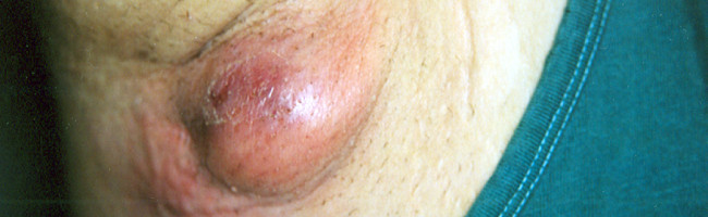 Do You Have Hidradenitis Suppurativa?