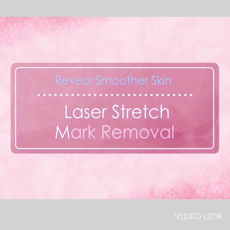 Laser Stretch Mark Removal 