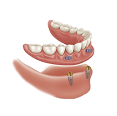 dental implants dentures