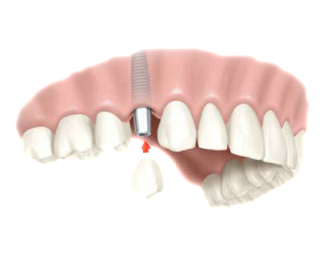 dental implant surgery