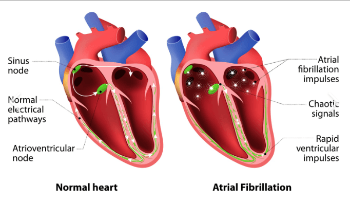 Heart Talk: Understanding AFib for Everyday People