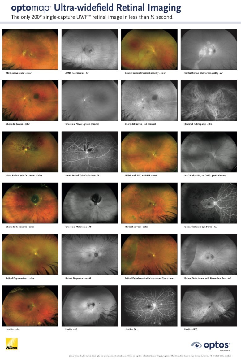 optomap ultra-widefield Retinal Imaging Poster