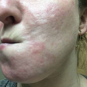 Dermatillomania aka Skin Picking Disorder,Excoriation