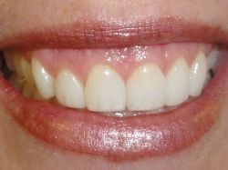 Smile Gallery : Dr. Michael P. Rack, DDS Dentist