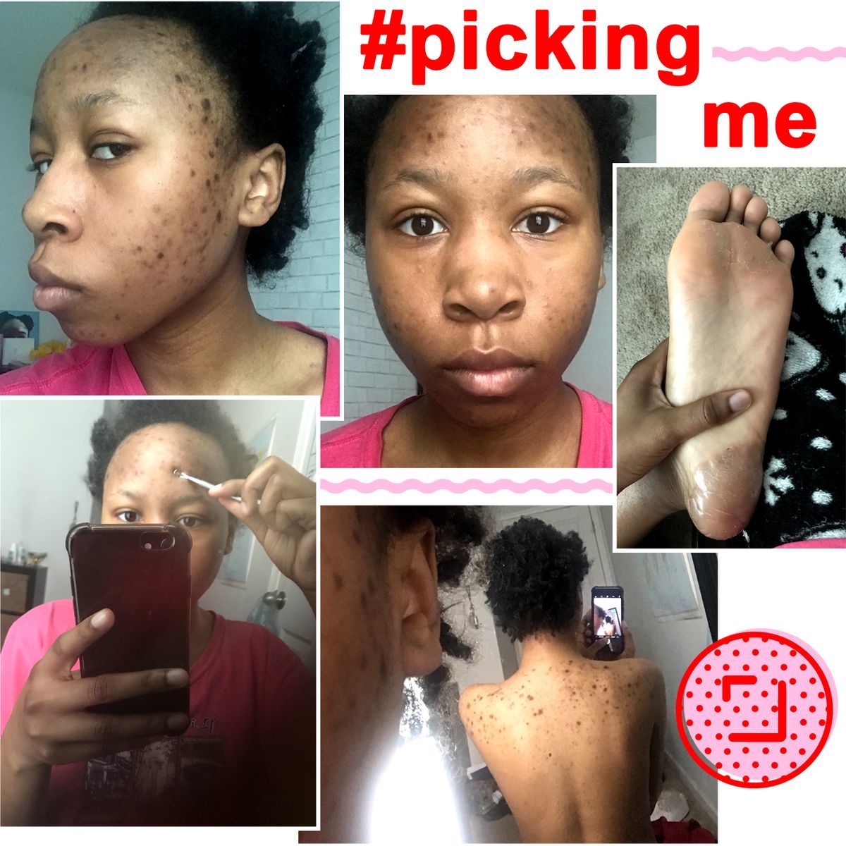 Dermatillomania aka Skin Picking Disorder/ Excoriation/ Excoriation