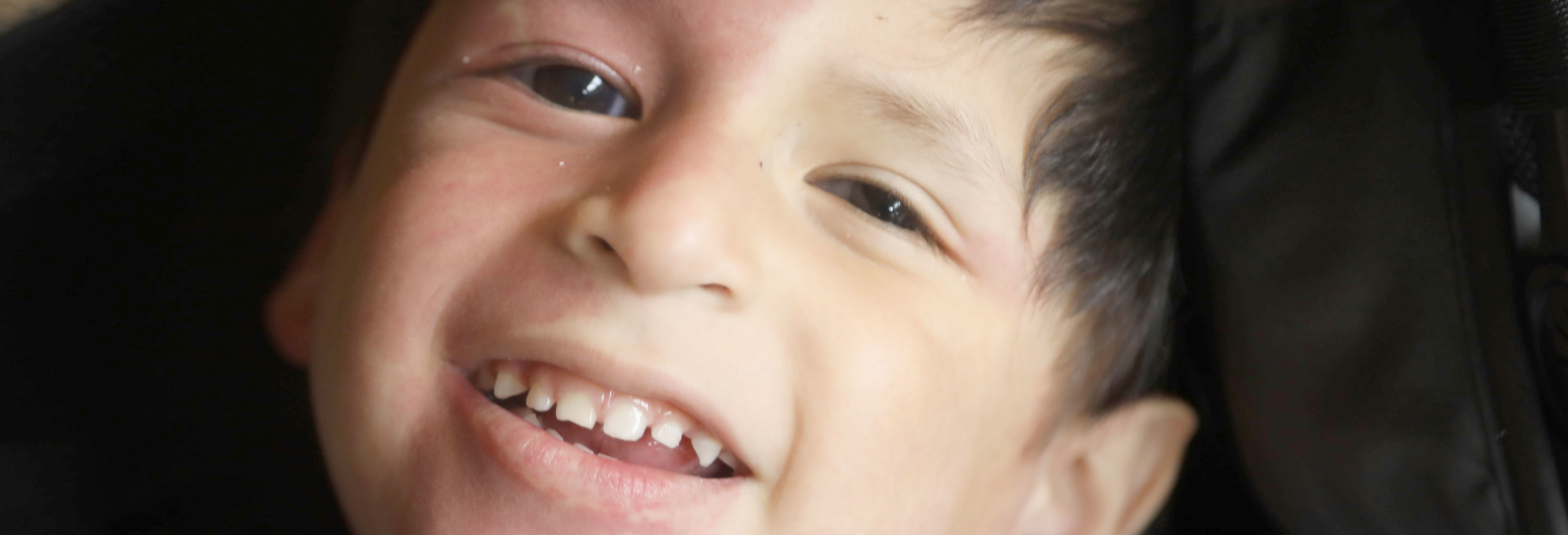 Close up of little boy smiling at the camera with a facial birthmark