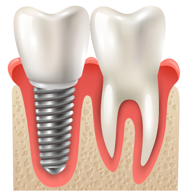Dental Services | Dental Implant Surgery | Dental Implant Dentist | Dental Surgery | Lincoln, NE |  Nebraska Oral & Facial Surgery