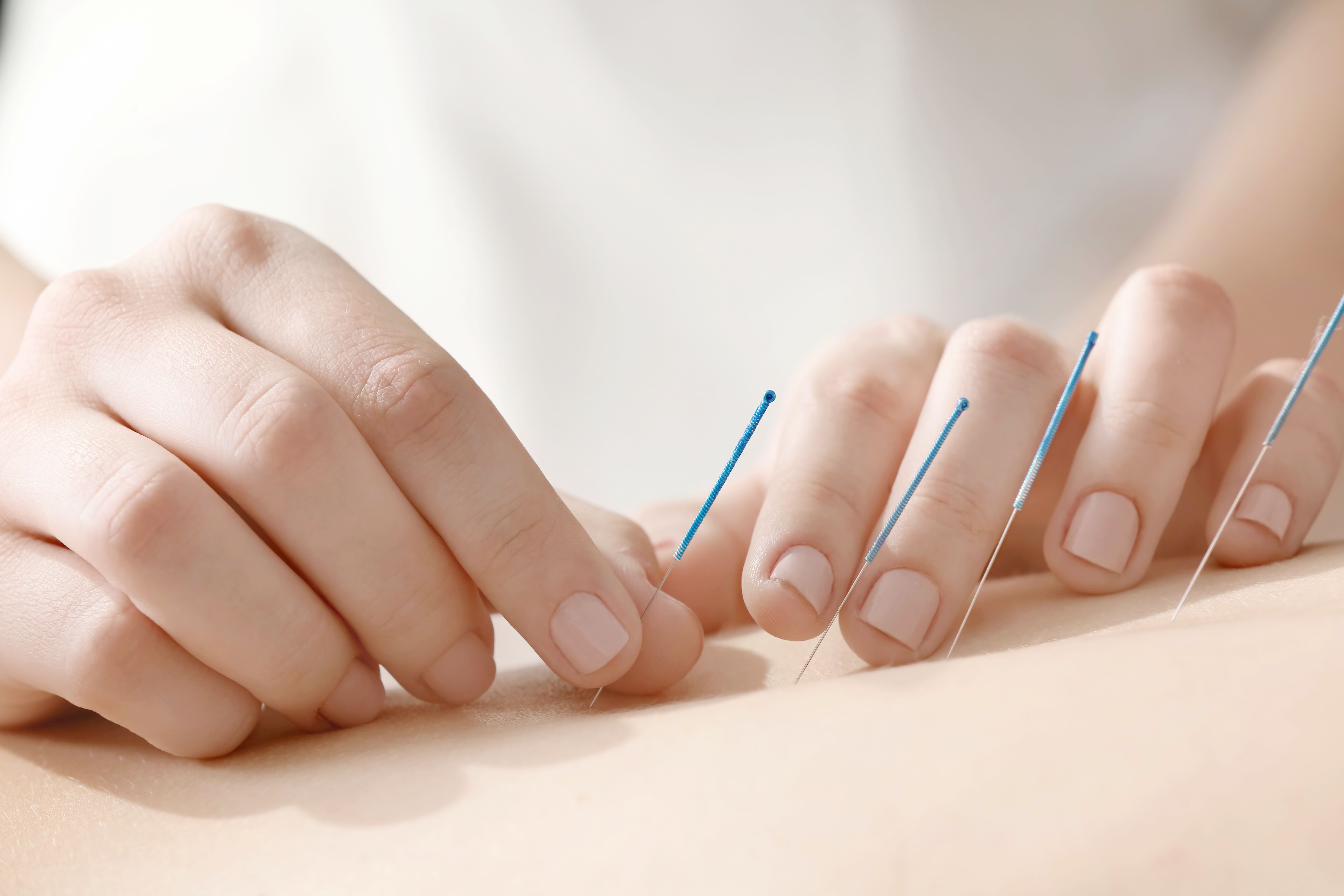 Managing Treatment Side Effects with Acupuncture