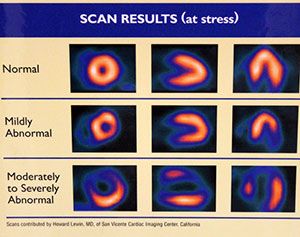abnormal heart stress test results