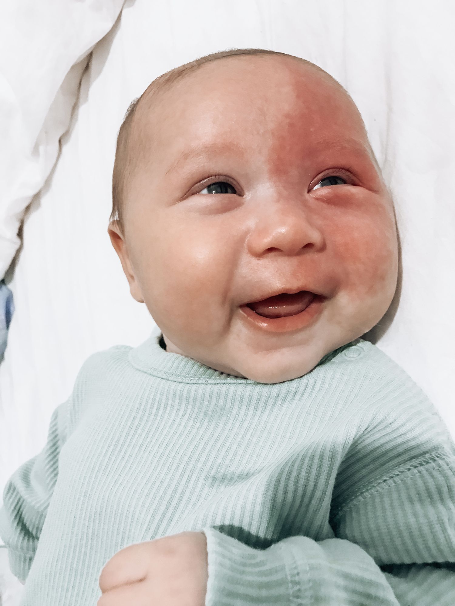 Little baby boy laughing at the camera with a birthmark on his face