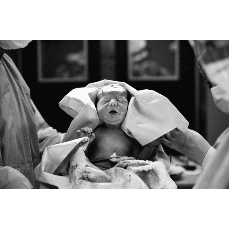Prevention of 1st Cesarean Delivery