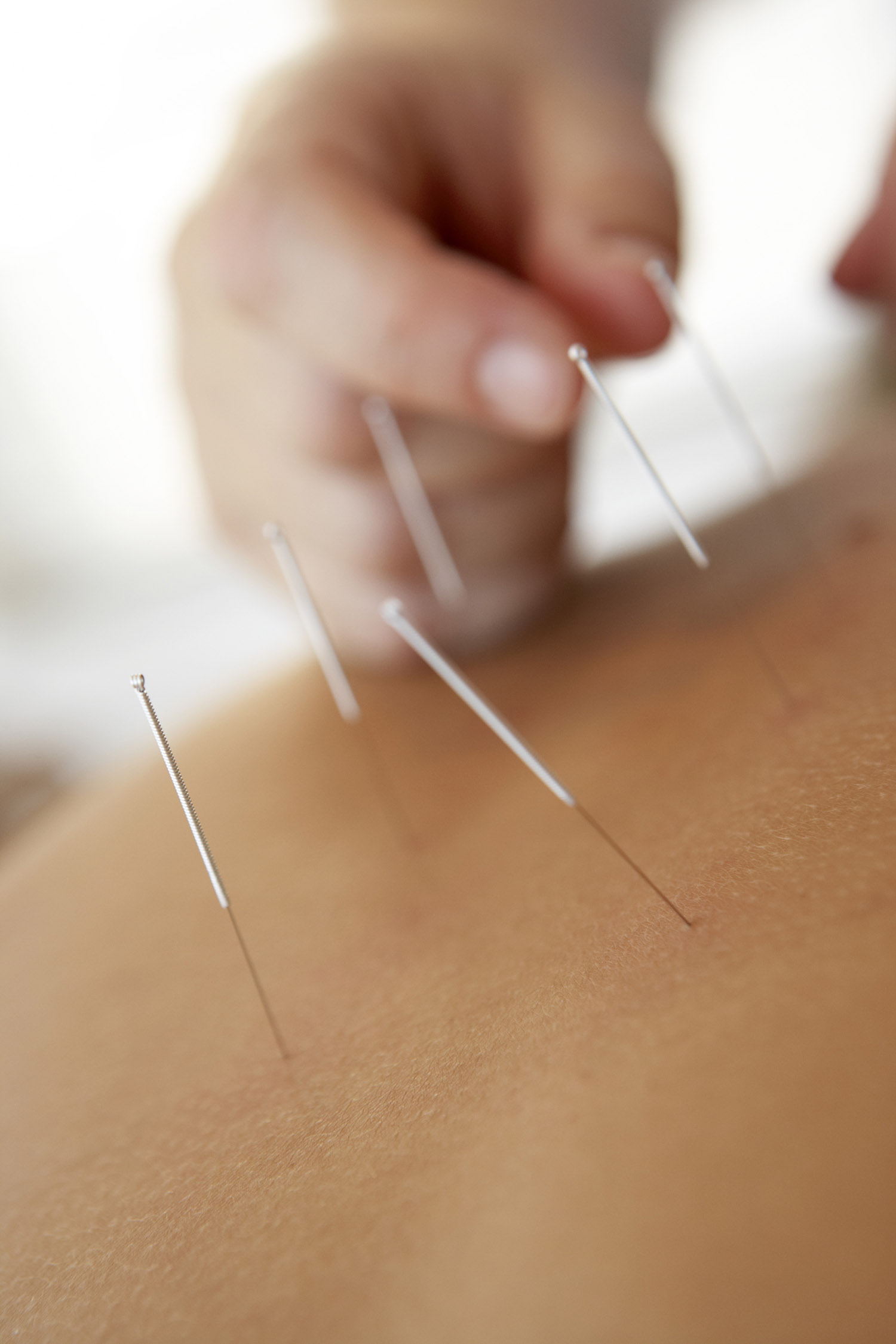 Acupuncture Workshop