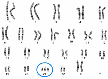 Karyotype showing 23 chromosome pairs; chromosome 21 has three copies.