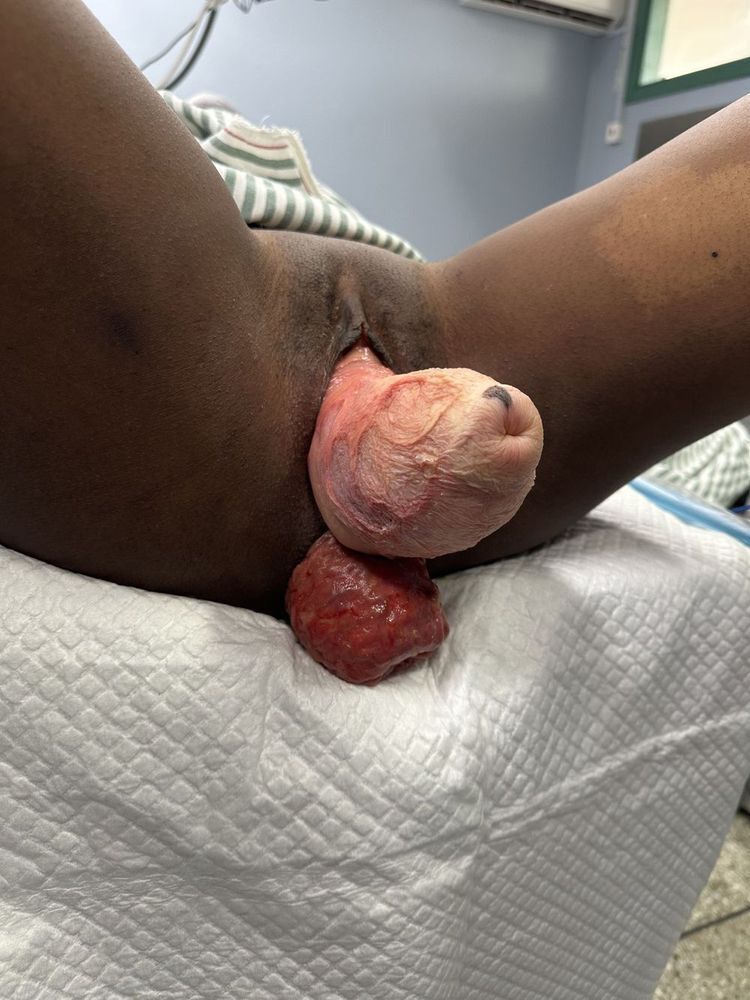 Vaginal and Rectal Prolapse - Before