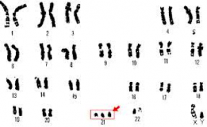 trisomy 21 down syndrome