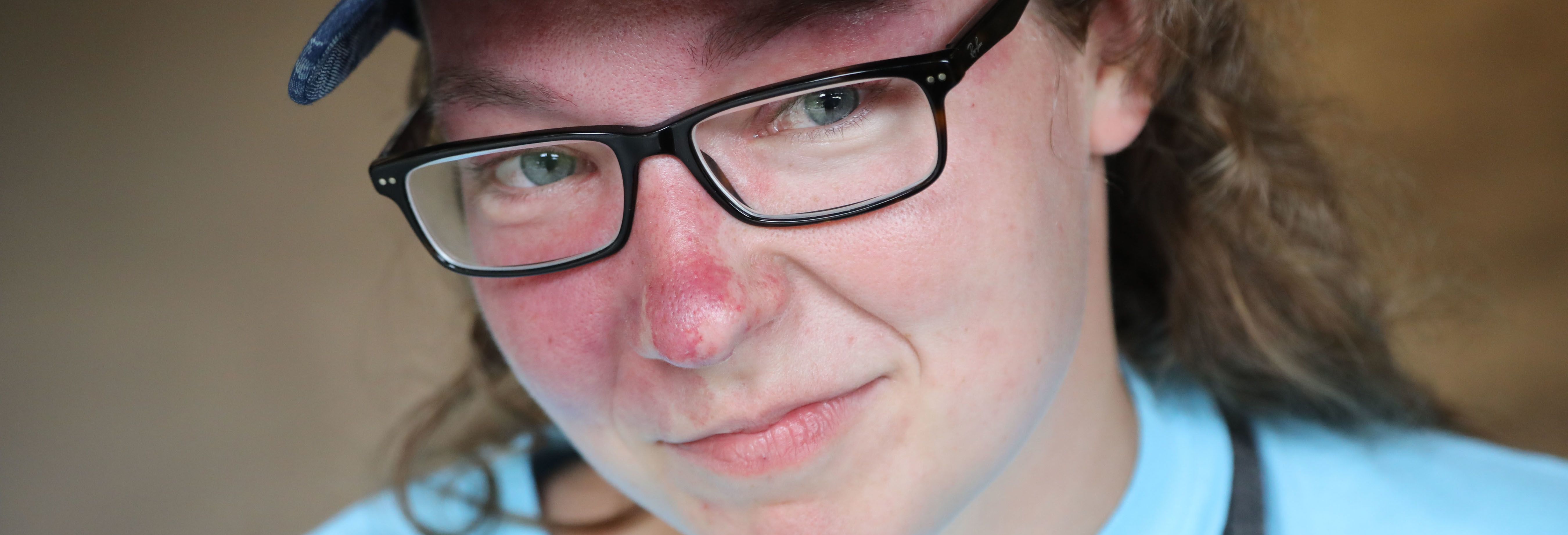 Close up of young woman in glasses and ball cap with facial birthmark