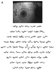 This is a picture of an eye with eye with progressive retinal degeneration