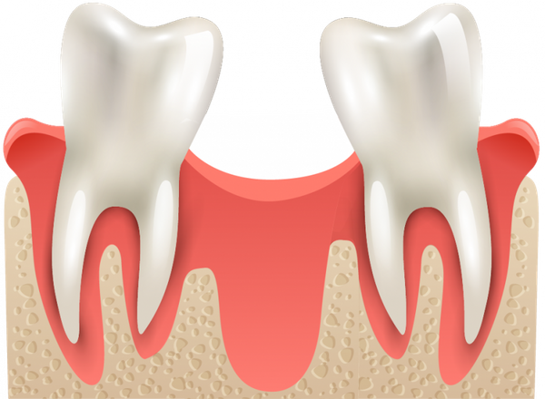 Jaw Bone Augmentation in Nebraska | Omaha Oral Surgery