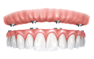dental implants dentures