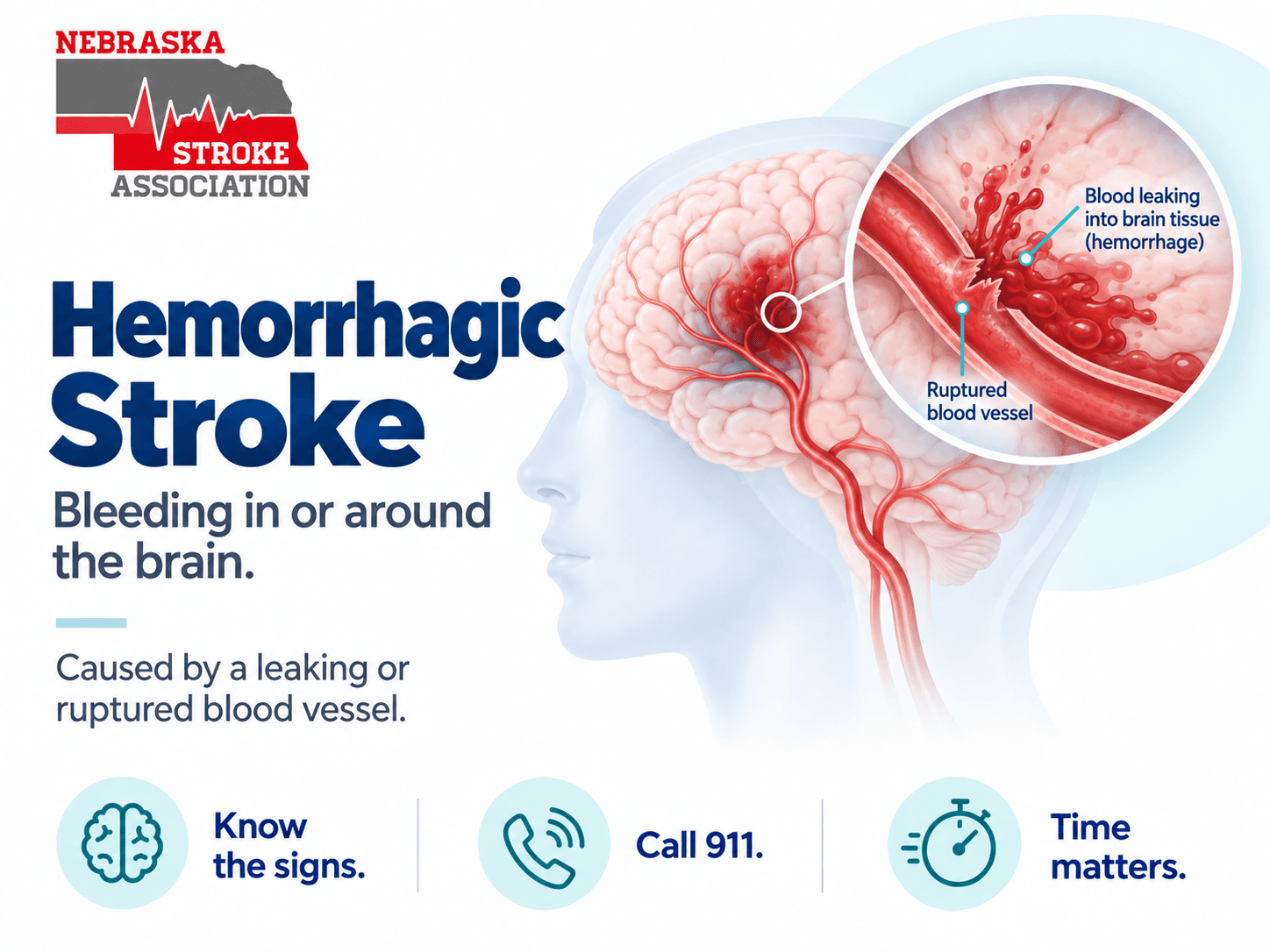 Hemorrhagic Stroke