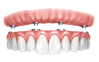 implant teeth