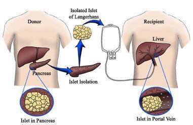 Islet Transplantation: A Brief Overview