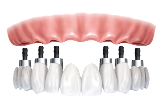 implant dentures