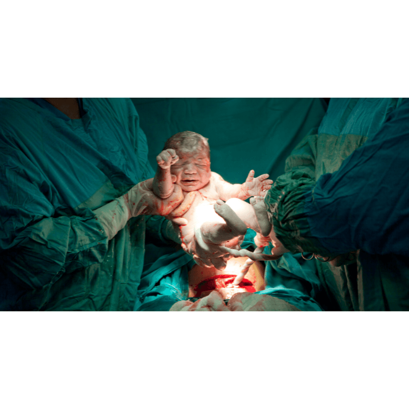 Prevention of 1st Cesarean Delivery