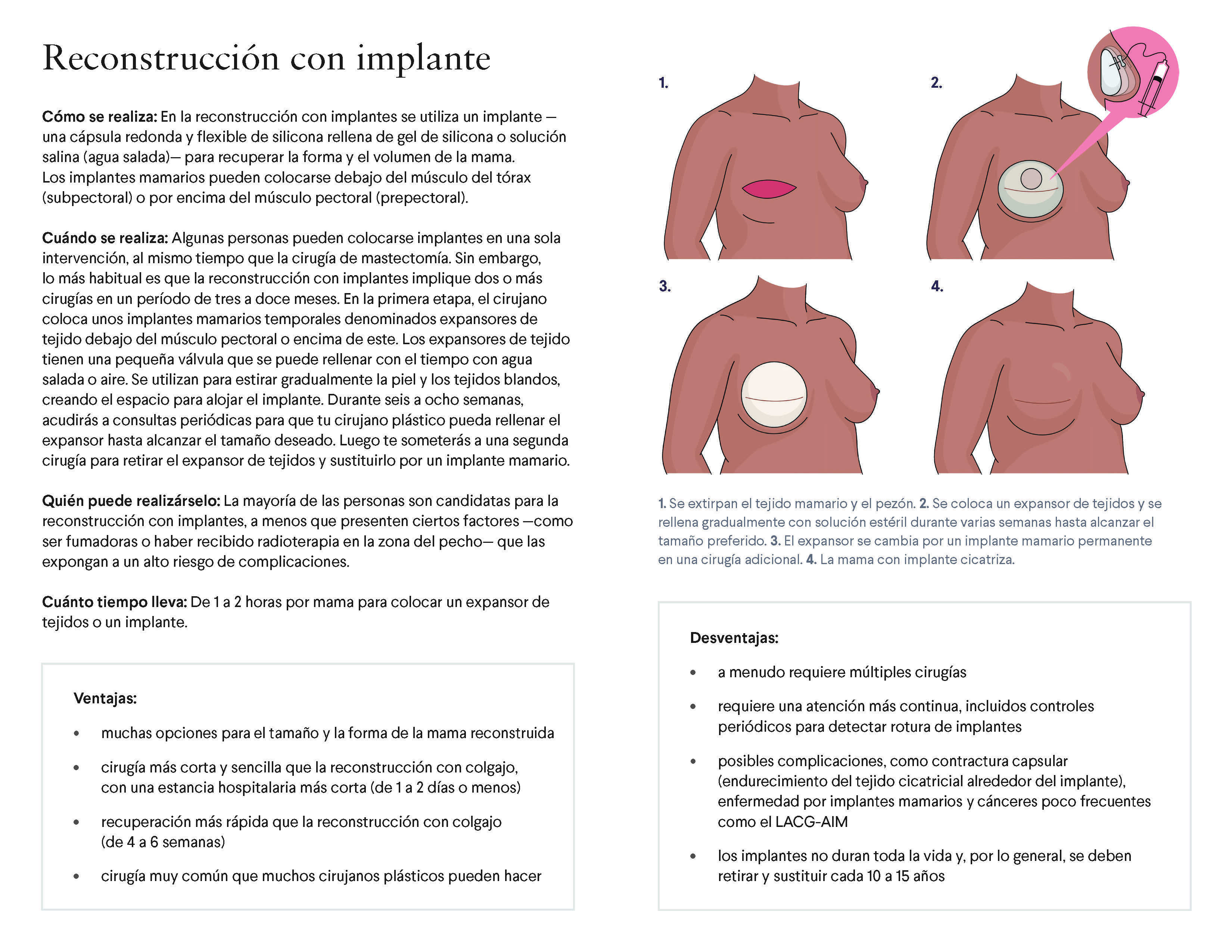 Breast Reconstruction: A Guide to Your Options (Spanish)
