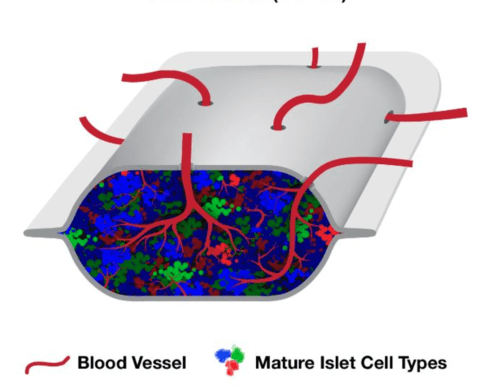 ViaCyte Overview: T1D Practical Cure Progress