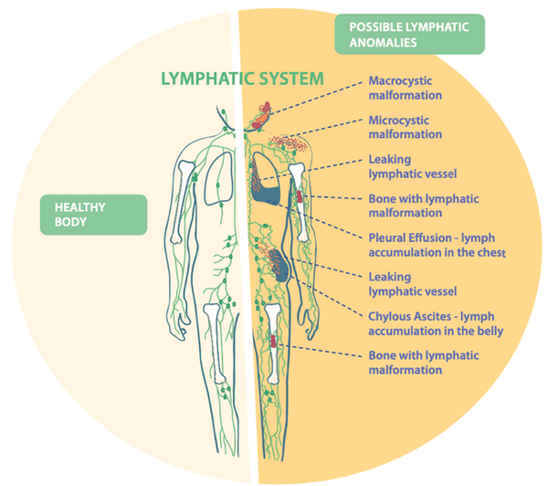 Lymphatic System : About CLAs : Lymphangiomatosis & Gorham's Disease ...