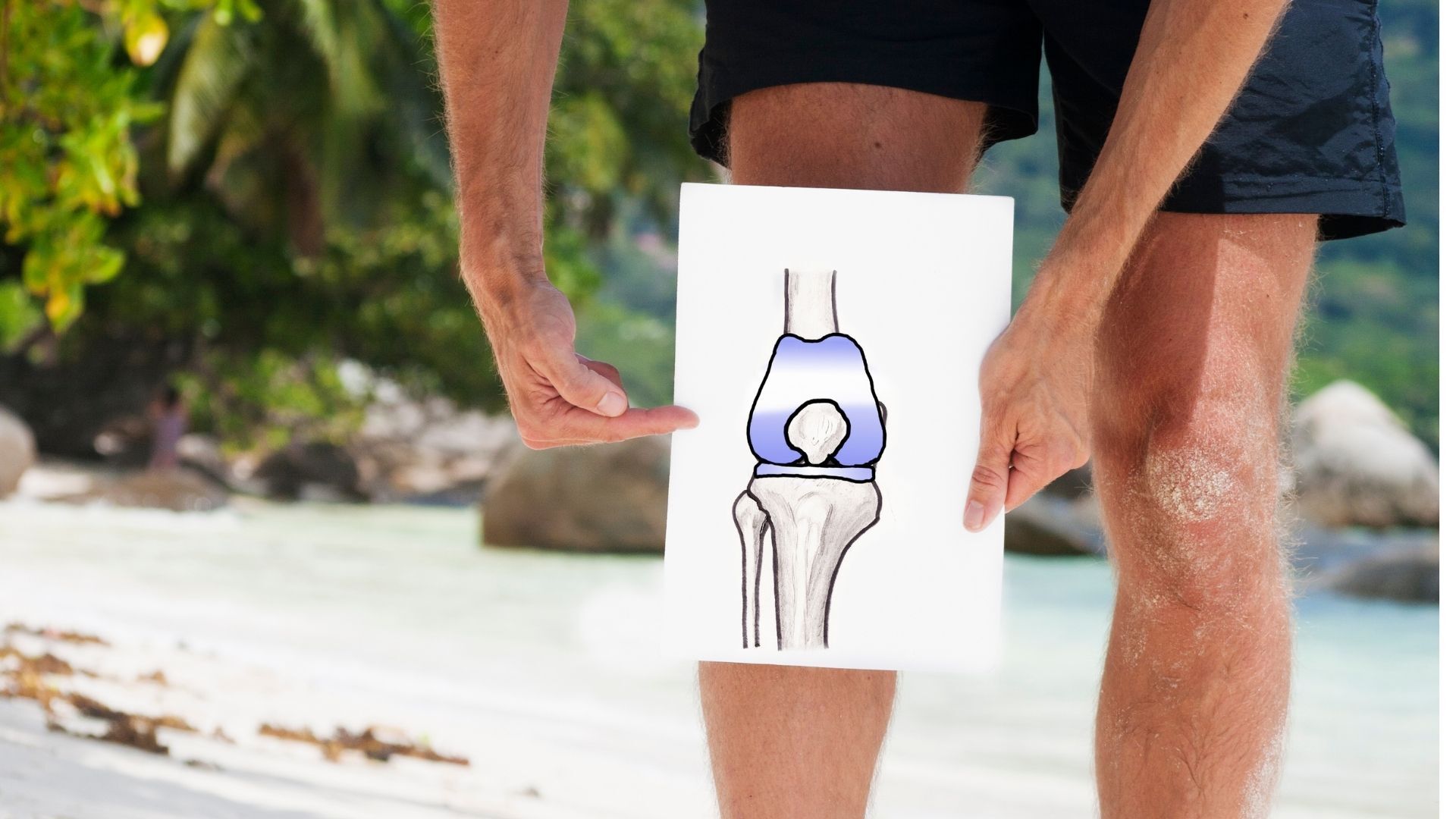 Knee Replacement Surgery Shown Through a Paper Diagram Over a Healthy Knee 