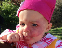 Small child with a pink cap and birthmark on the face
