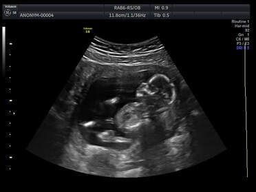 Ultrasound of a baby in the womb.