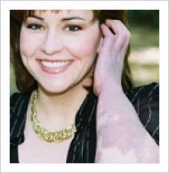 Young woman looking at the camera, tucking her hair behind her ear. She has Klippel-Trenaunay Syndrome mark on her arm.