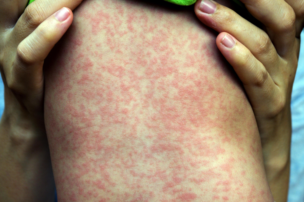 Ukraine tops list of countries with highest reported incidence rate of measles in 2018: UNICEF