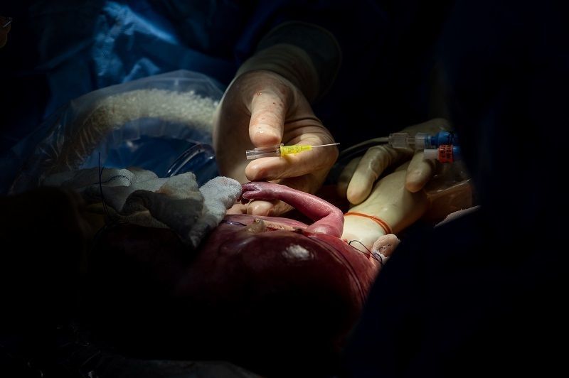 Unborn Baby Removed From Mother’s Womb for Lung Surgery, Then Put Back In