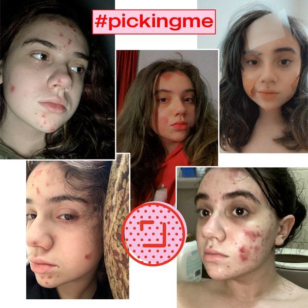 Dermatillomania aka Skin Picking Disorder/ Excoriation/ Excoriation