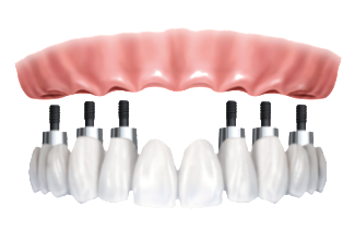 denture implants