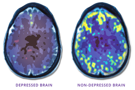 Depressed Brain Vs. Non-Depressed Brain